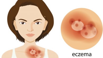 Advantan M Losyon Nedir
