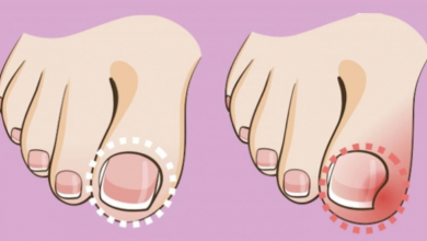 Tırnak Batması Neden Olur? Nasıl Tedavi Edilir?