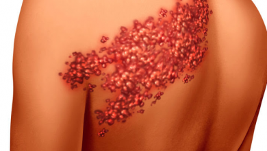 Zona Hastalığında Banyo Yapılabilir mi?